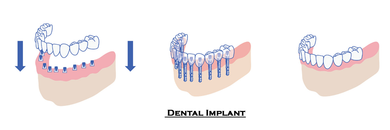 Best Dental Implant Clinic in Pimpri Chinchwad Pune